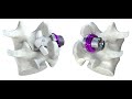 The Minuteman Procedure Minimally Invasive Spinal Fusion