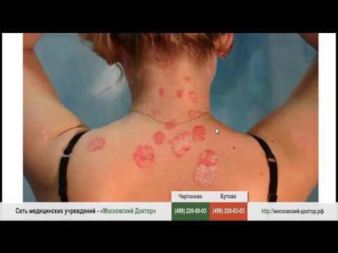 Веснушки лице после родов Как скрыть пигментные пятна на лице отзывы