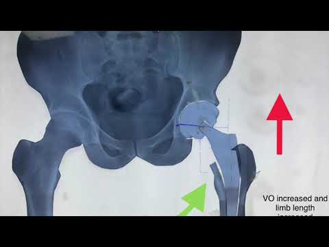 Total Hip Arthroplasty: Using Implant To Your Advantage