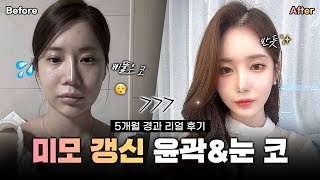 [리얼모델 VLOG] 미모 갱신한 윤곽 눈 코 5달 경과 리얼 후기 #일퍼센트성형외과