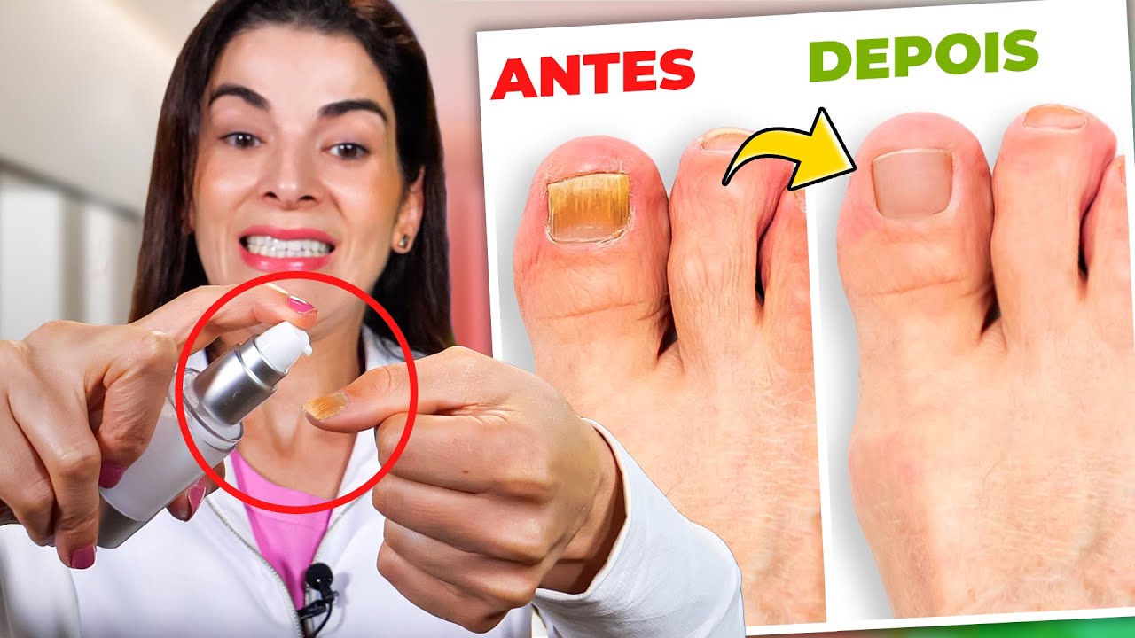 Receita para CURAR MICOSE DE UNHA e Acabar com os Fungos!