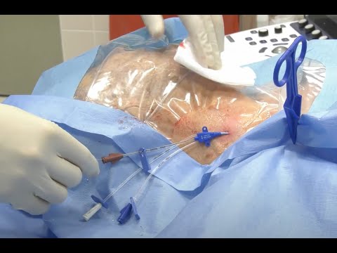 Central venous catheter insertion (Internal jugular vein)