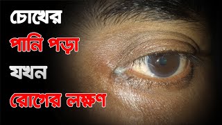 যে সকল রোগে চোখের পানি পড়ে | Eye Discharge | Dr. Md Abid Akbar | Oculoplastic & Ocular Oncologist