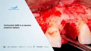 Download lagu Horizontal GBR in a severe anterior defect. mp3 Download lagu Horizontal GBR in a severe anterior defect. mp3