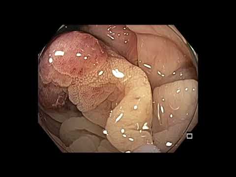 Colonoscopy: Sigmoid Colon Pedunculated Polyp Resection