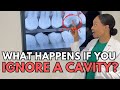 Cavities 101 What Happens If You Ignore A Cavity Dr Alexis Washington Washington Metro Dental
