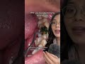 Good Stuck Inside A Tooth Cavity Cavity Mouth Food Dentist