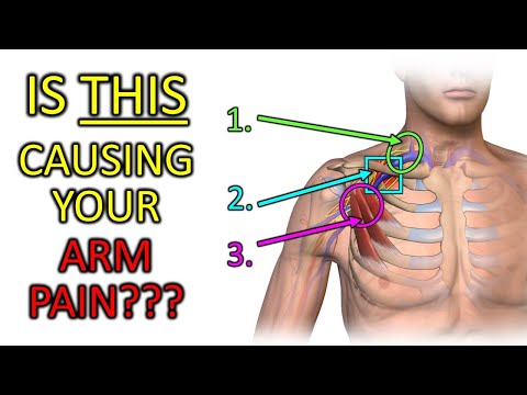 Fix Thoracic Outlet Syndrome: Is THIS Causing Your Arm Pain or Tingling?