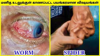 உடலுக்குள் உயிரினங்கள் | Weird Things Found Inside Human In Tamil | Human Body | TAMIL AMAZING FACTS video