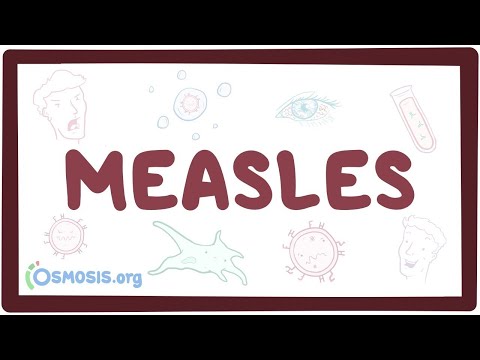 Measles - causes, symptoms, diagnosis, treatment, pathology