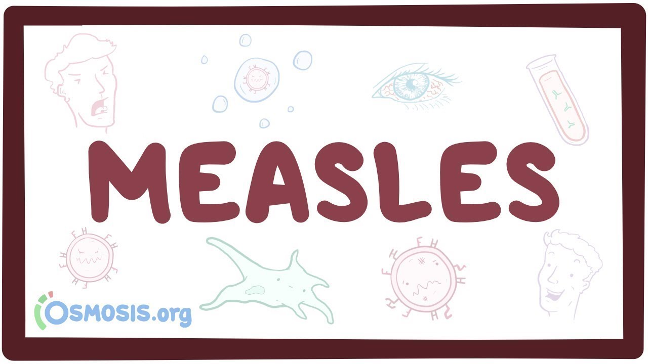 Measles - causes, symptoms, diagnosis, treatment, pathology