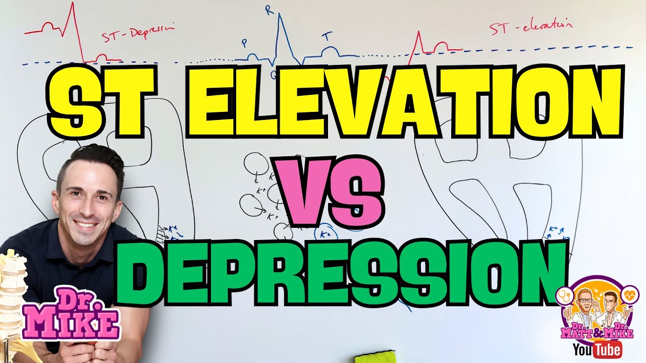 ST Elevation vs ST Depression