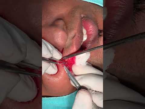 Large Scar Revision On The Nose And Upper Lip