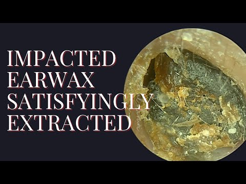 Impacted Earwax Satisfyingly Extracted