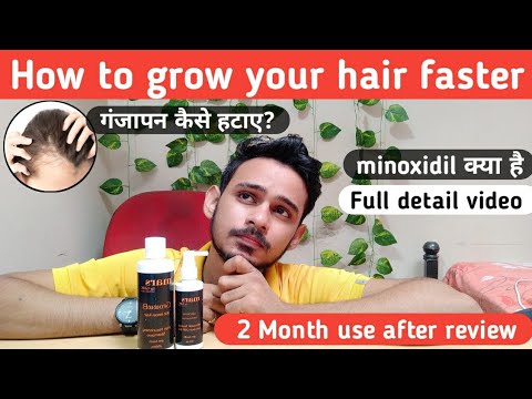 गंजापन का इलाज || How to grow your hair faster | mars by ghc minoxidil review | minoxidil