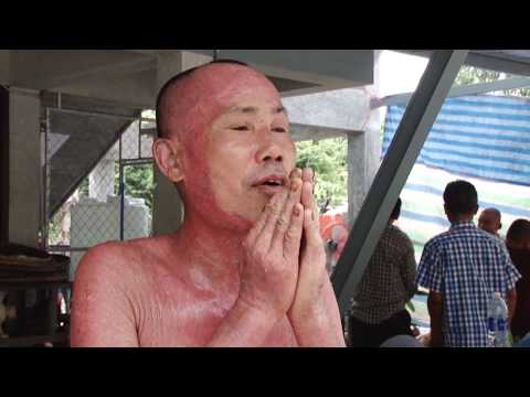 ร่วมโรคสะเก็ดเงิน กลาก herpetic ในเด็ก