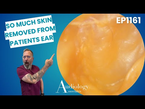 So Much Skin Removed From A Patients Ear   EP1161