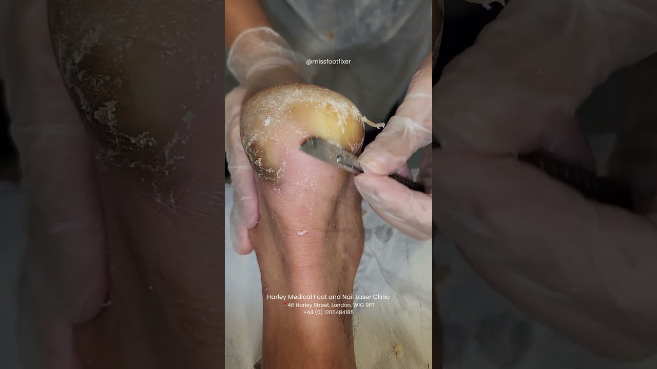 Callus Removal in Progress (So Satisfying) by Miss Foot Fixer Marion Yau