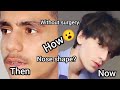 How I Changed My Nose Shape Natural Glow Up