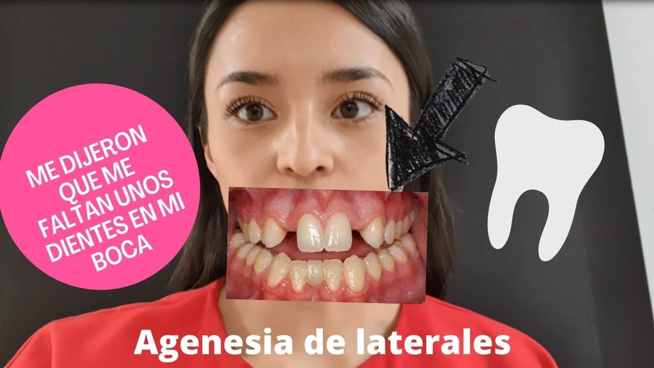 AGENESIA DE LATERALES  + FOTOGRAFÍA EXTRAORAL