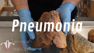 Pneumonia