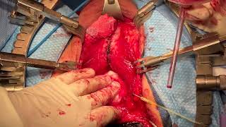 Core Videos (2023): Posterior Urethroplasty for Pelvic Fracture Urethral Injury