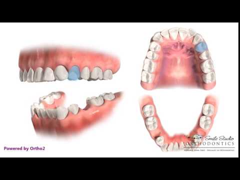 Upper 4 Lower 5 Extraction - Orthodontic Treatment