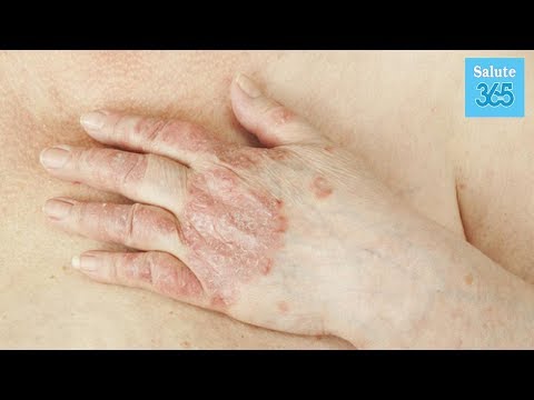 Unguenti e gel a dermatite o eczema Se la trasfusione del sangue a eczema aiuta