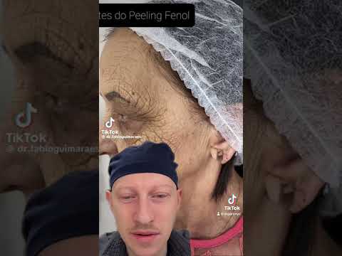 Incredible Chemical Peel Result | Plastic Surgeon Reacts