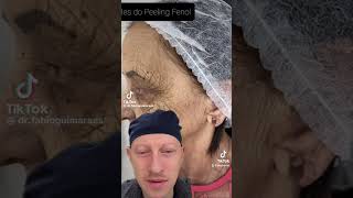 Incredible Chemical Peel Result | Plastic Surgeon Reacts