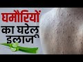 Ghamoriyon Ke Gharelu Ilaaj घमौरियों का इलाज हैं ये घरे�