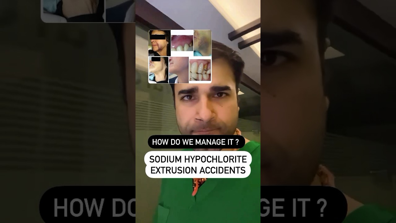 Sodium hypochlorite extrusion accident: #dentistry #endodontics #dentalstudent #dentaleducation