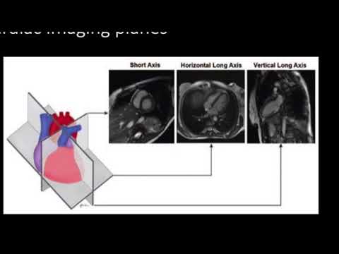 TMT: Cardiac MRI: Scanning Planes