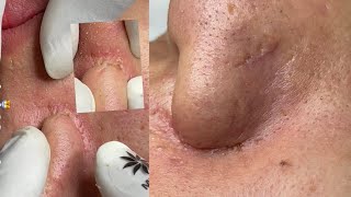 Relaxing Acne Cleansing with LinhMyDang  #600