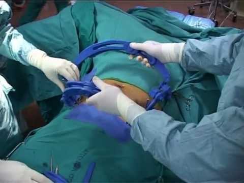 Mal di schiena e parto delladdome Menu di dieta in osteocondrosi della colonna vertebrale per una settimana
