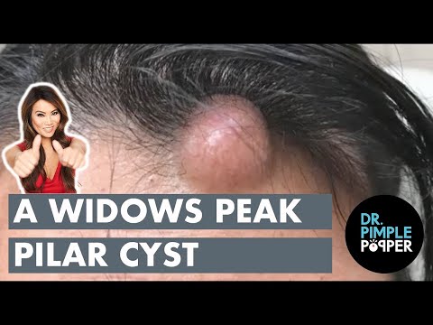 A Widow's Peak Pilar Cyst