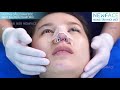 Nhật ký sửa mũi bị lệch vẹo, lộ sống và da mũi mỏng từng nâng mũi 1 năm