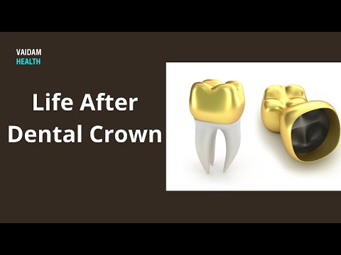 Life After Dental Crown