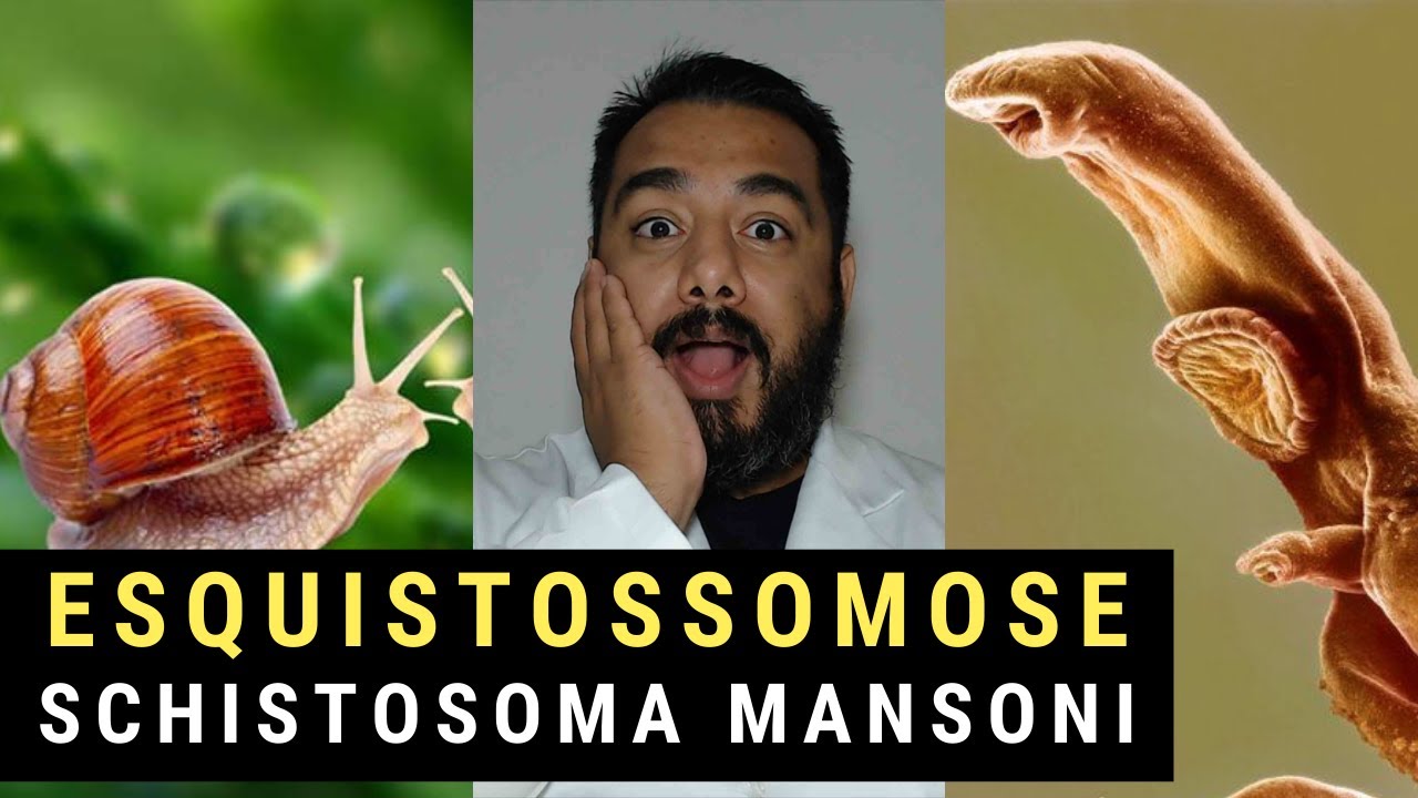 Esquistossomose ou Barriga D’Água (Schistosoma mansoni): Curso de Parasitologia Humana