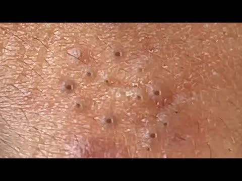 Blackheads & Whiteheads Satisfying Removal Acne and Pimple @08034