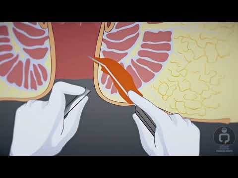 ANAL FISTULA LASER CLOSURE