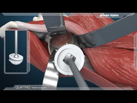 Anterior Approach & Dual Mobility Acetabular Component 3D Animation
