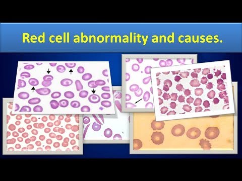 Red cell abnormality and causes.