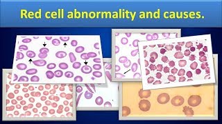 Red cell abnormality and causes.