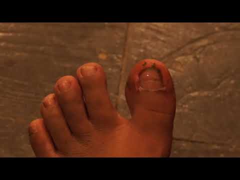ในการรักษาโรคสะเก็ดเงินขี้ผึ้ง การรักษา neurodermatitis วิธีแห่งชาติ