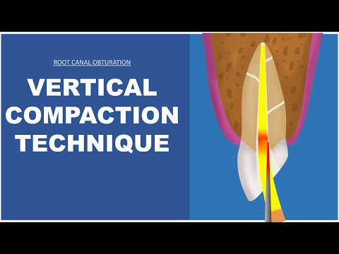 Vertical Compaction Technique | Root Canal Obturation