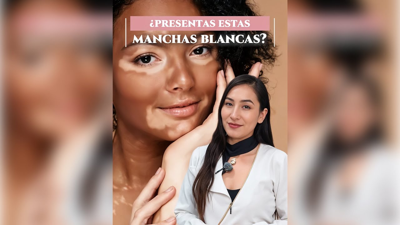 🐼¿Has notado manchas blancas en tu piel? - Dra. Gisela Pilar Aire Farfán