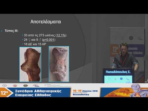 Σ. Παπαδόπουλος - Ταξινόμηση της μορφολογίας της αρθρικής επιφάνειας του ωλεκρανου σε τύπους και κλινική σημασία