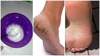 HOW TO REMOVE DEAD SKIN CELLS FROM YOUR FEET IN MINUTES | Foot Care Routine. TRY this magical remedy