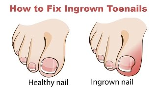 How to Fix Ingrown Toenails Quickly and Easily